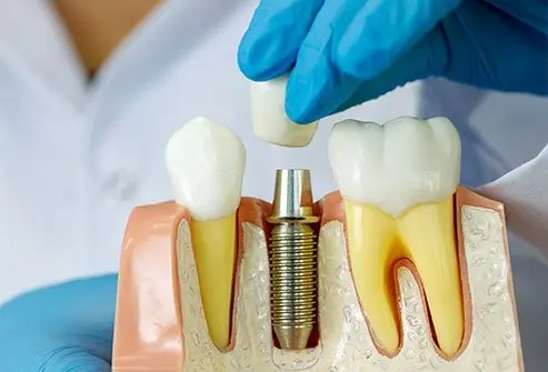 Dentist Supports